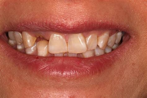 tooth implant in ashford|Repton Dental Studio – Dental Implants in Kent.